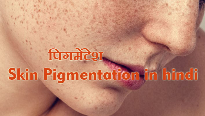 पिगमेंटेशन-Skin Pigmentation in hindi
